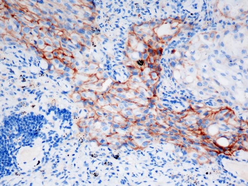 肺癌 PD-L1（BP6141）染色