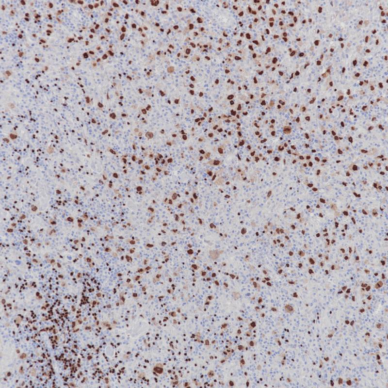 经典型霍奇金淋巴瘤 Pax-5 (BP6140) 染色