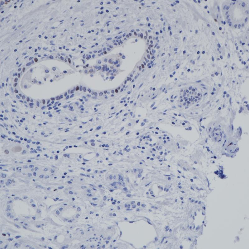 前列腺癌 AR V7 (BP6152) 染色