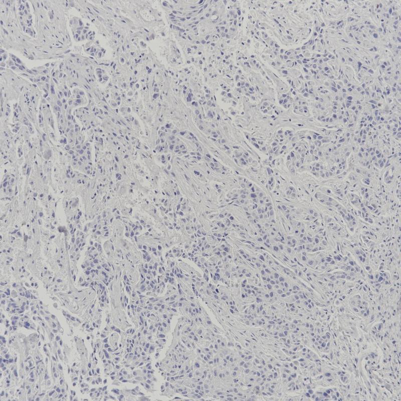 乳腺癌ERα (-)(BP6139)染色.jpg
