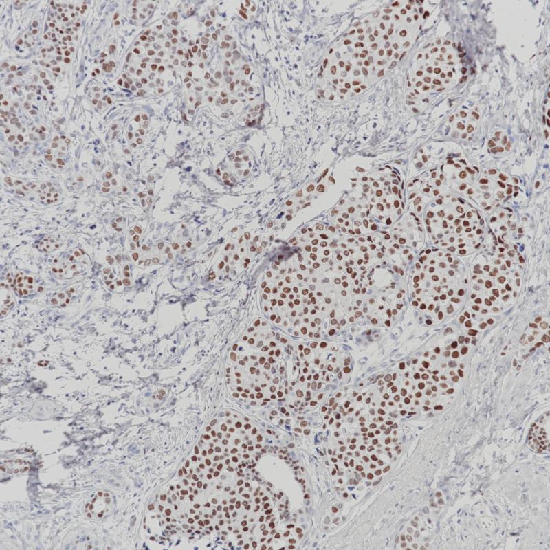 乳腺癌 ERα(+) (BP6139) 染色