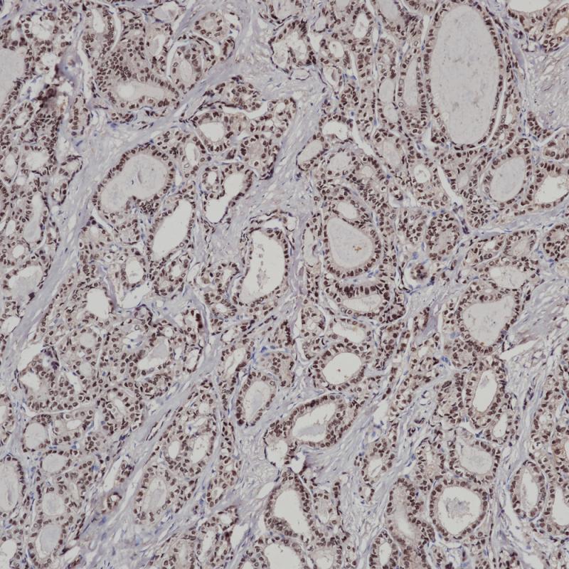 甲状腺癌 PAX-8 (BP6157) 染色