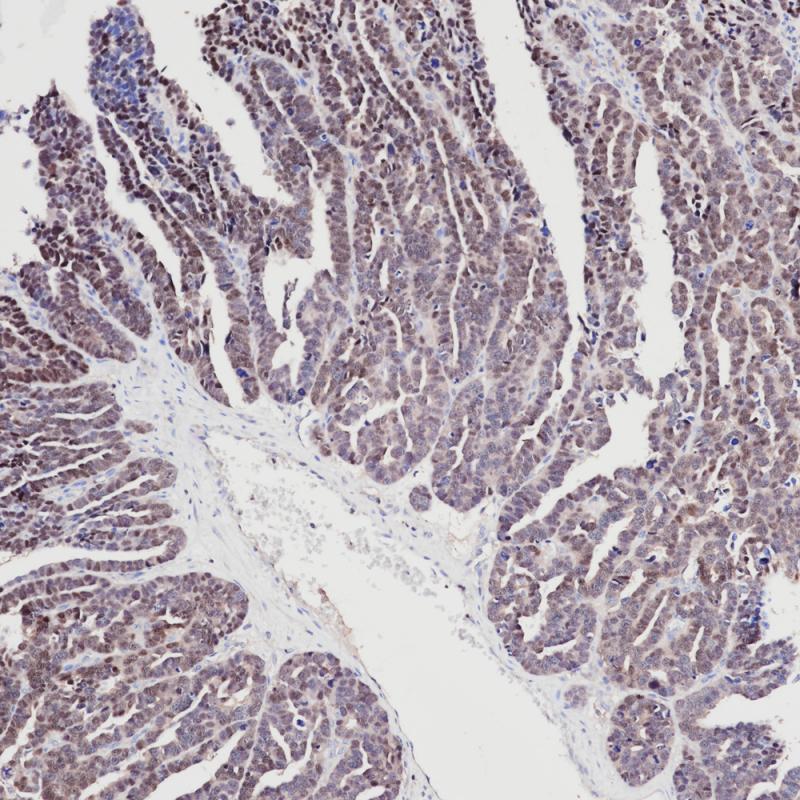浆液性卵巢癌 PAX-8 (BP6157) 染色