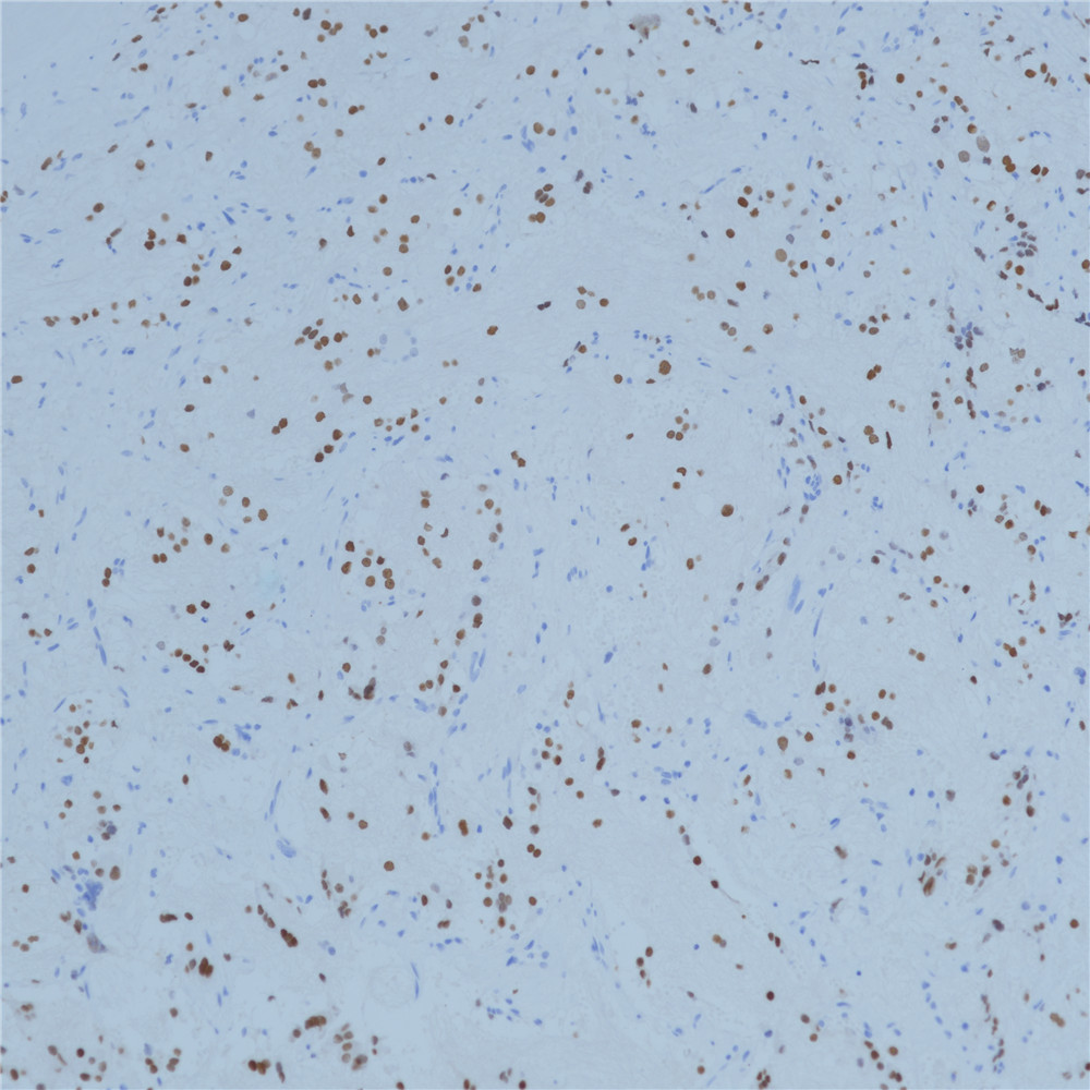 神经母细胞瘤PHOX2B（BP6154) 染色