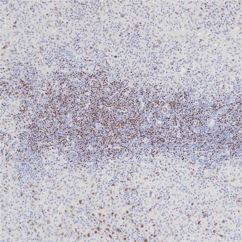 霍奇金淋巴瘤PAX-5(BPM6172)染色.jpg