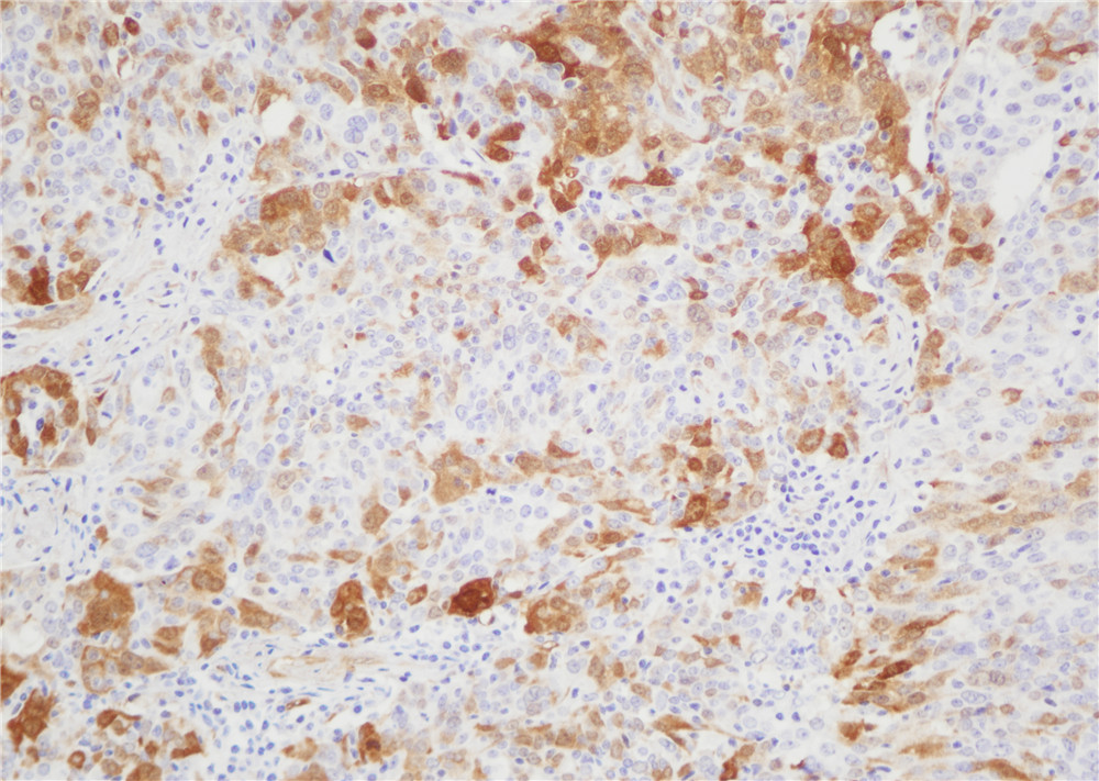 卵巢癌p16(BPM6147)染色