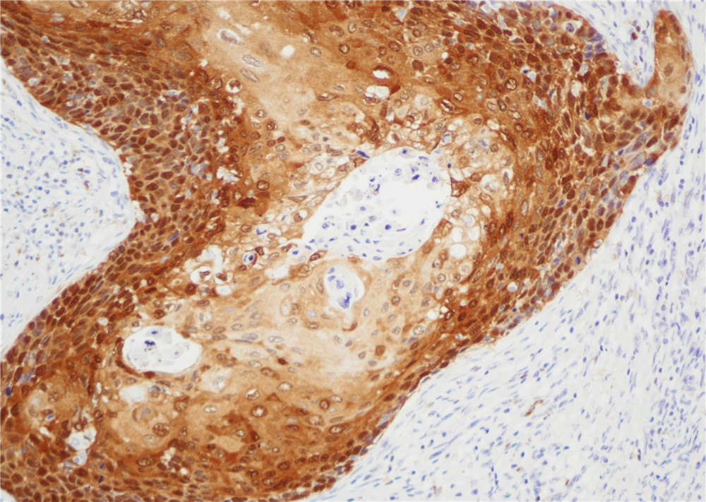 宫颈癌p16(BPM6147)染色