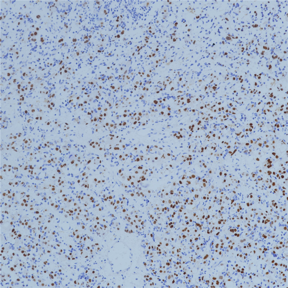 胚胎型横纹肌肉瘤Myogenin(BP6137)染色