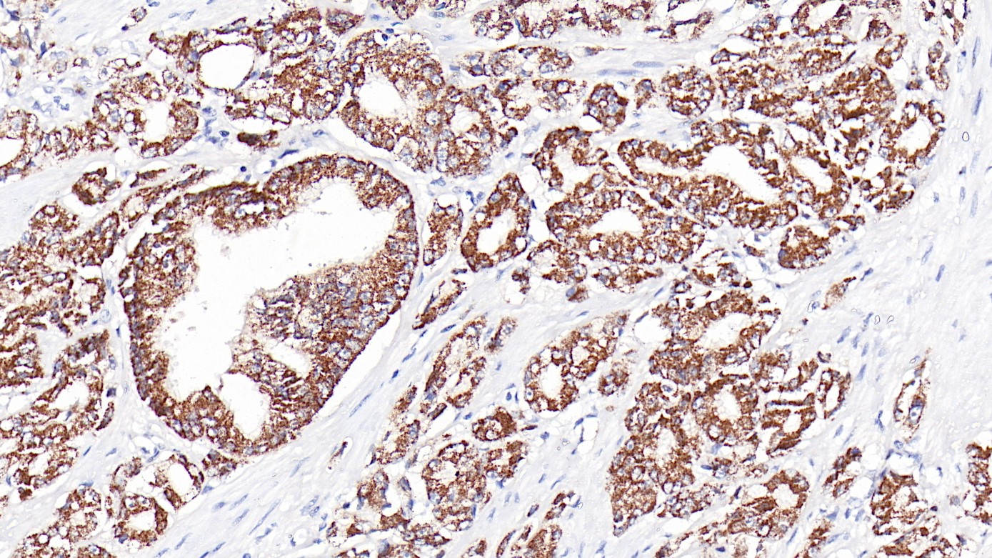 前列腺癌 AMACR(CMA158)染色