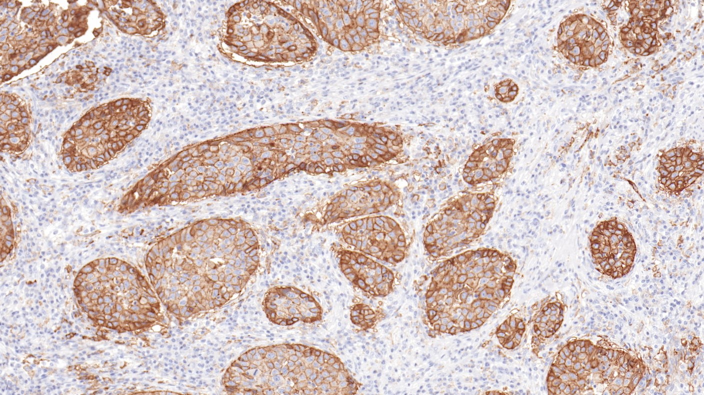 膀胱癌PD-L1(BP6099)染色