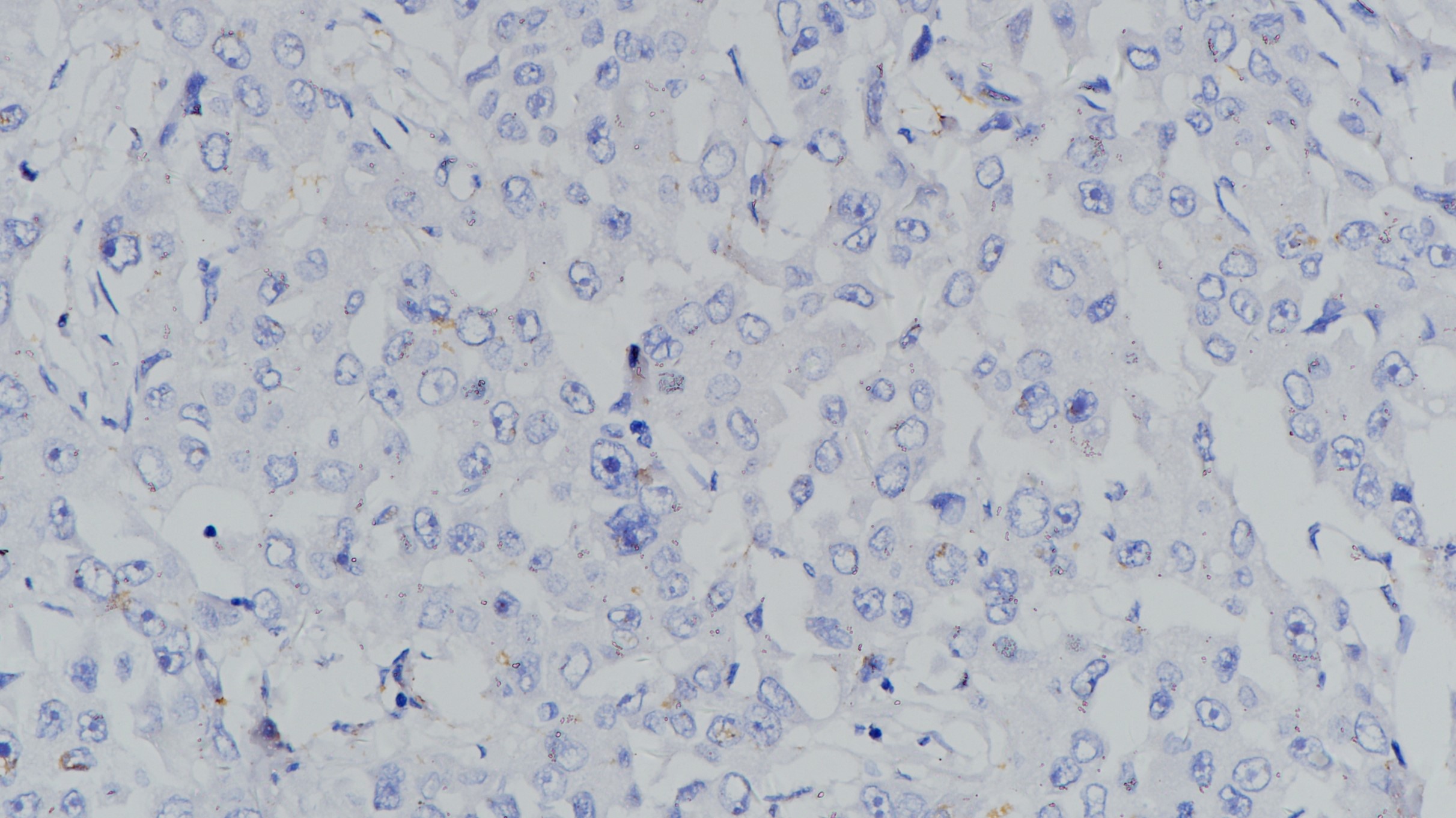 SALL4(6E3)肝癌 阴性组织染色