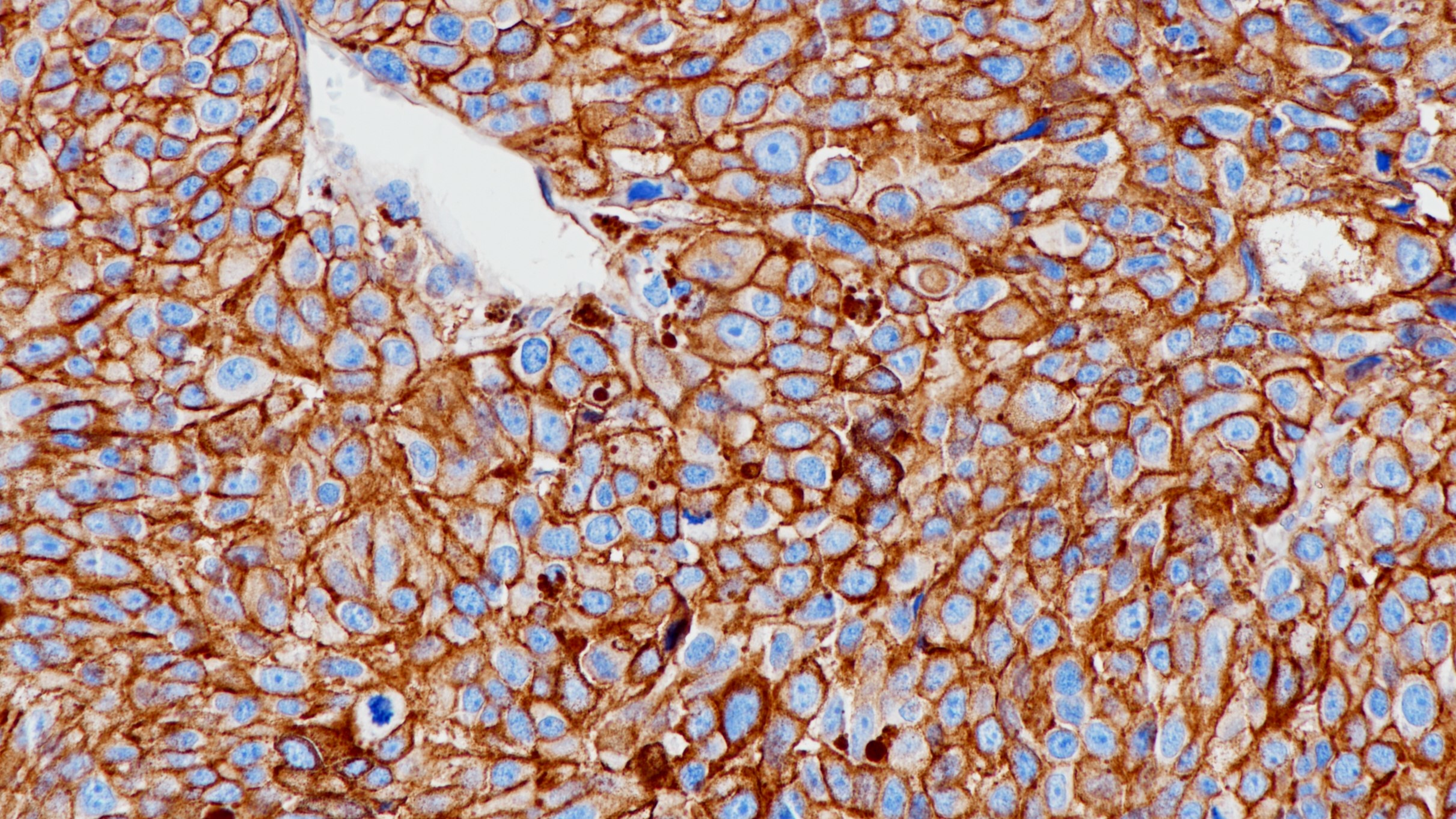 黑色素瘤CD146(BP6162)染色