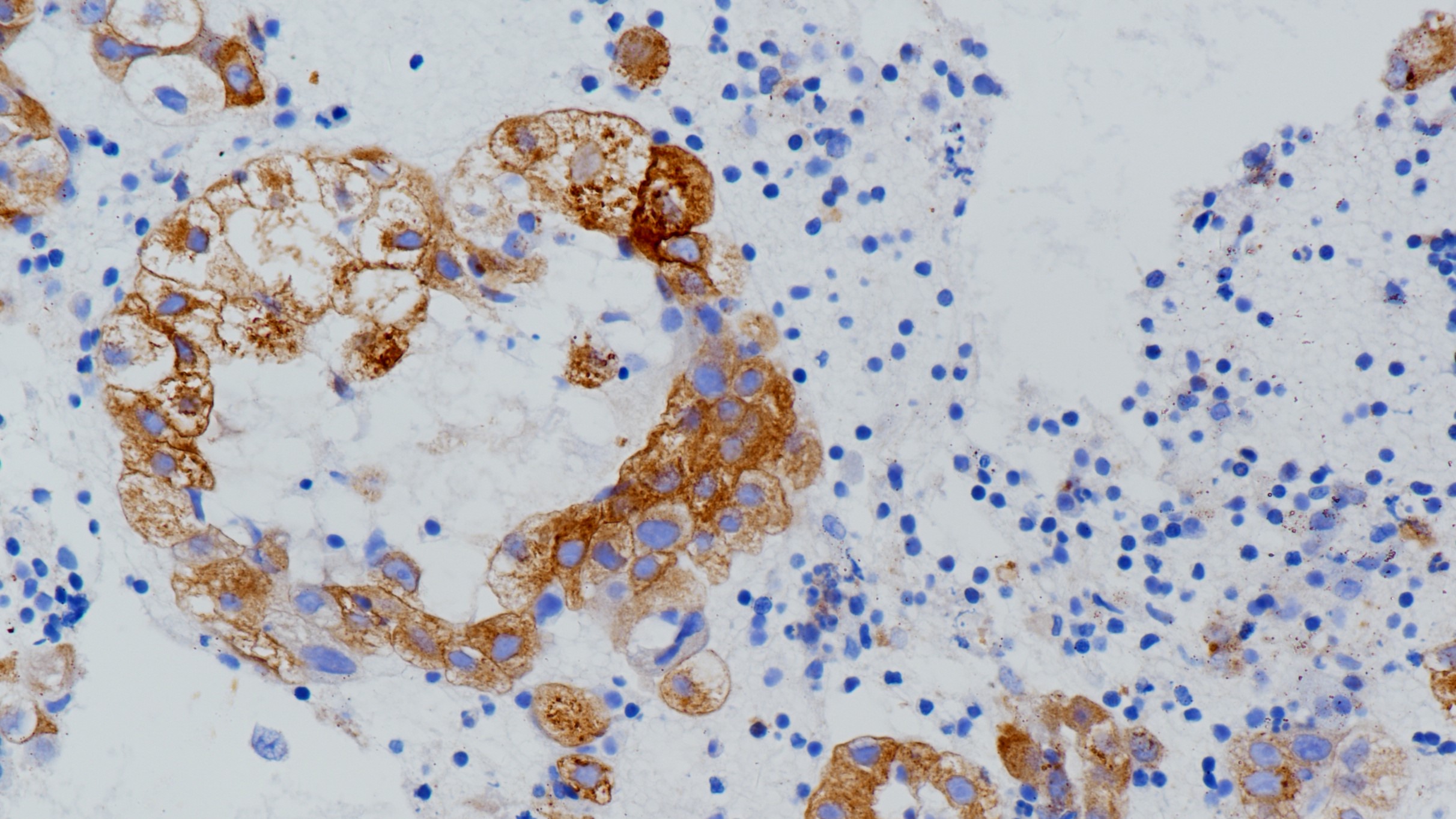 ROS1(D4D6)非小细胞肺癌 阴性组织染色