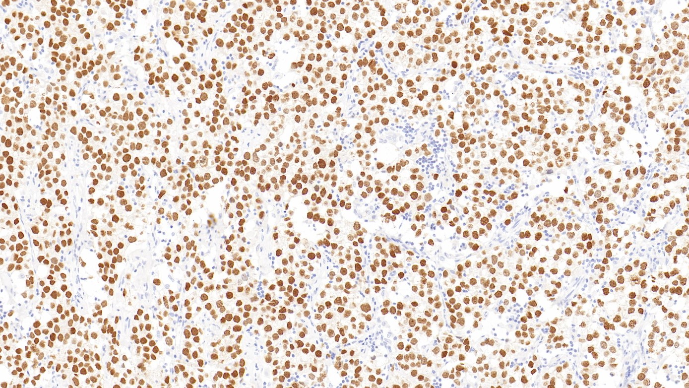 精原细胞瘤SALL4(6E3)染色
