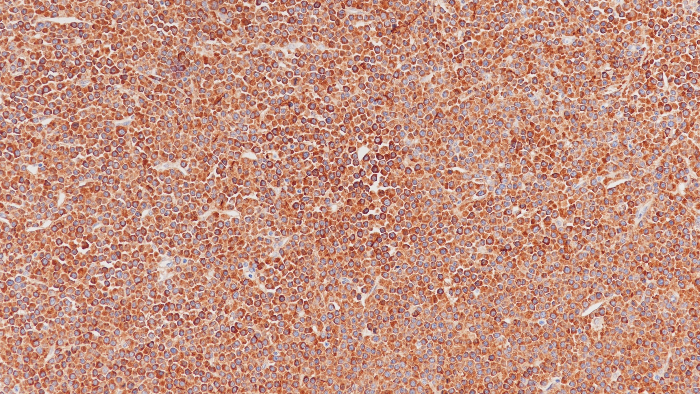 浆细胞瘤IgA(BP6169)染色