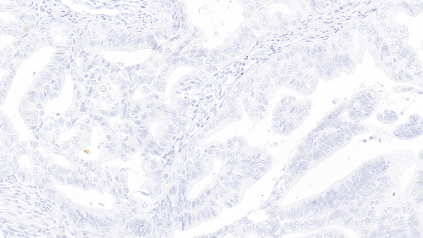 肺腺癌ROS1(D4D6)染色