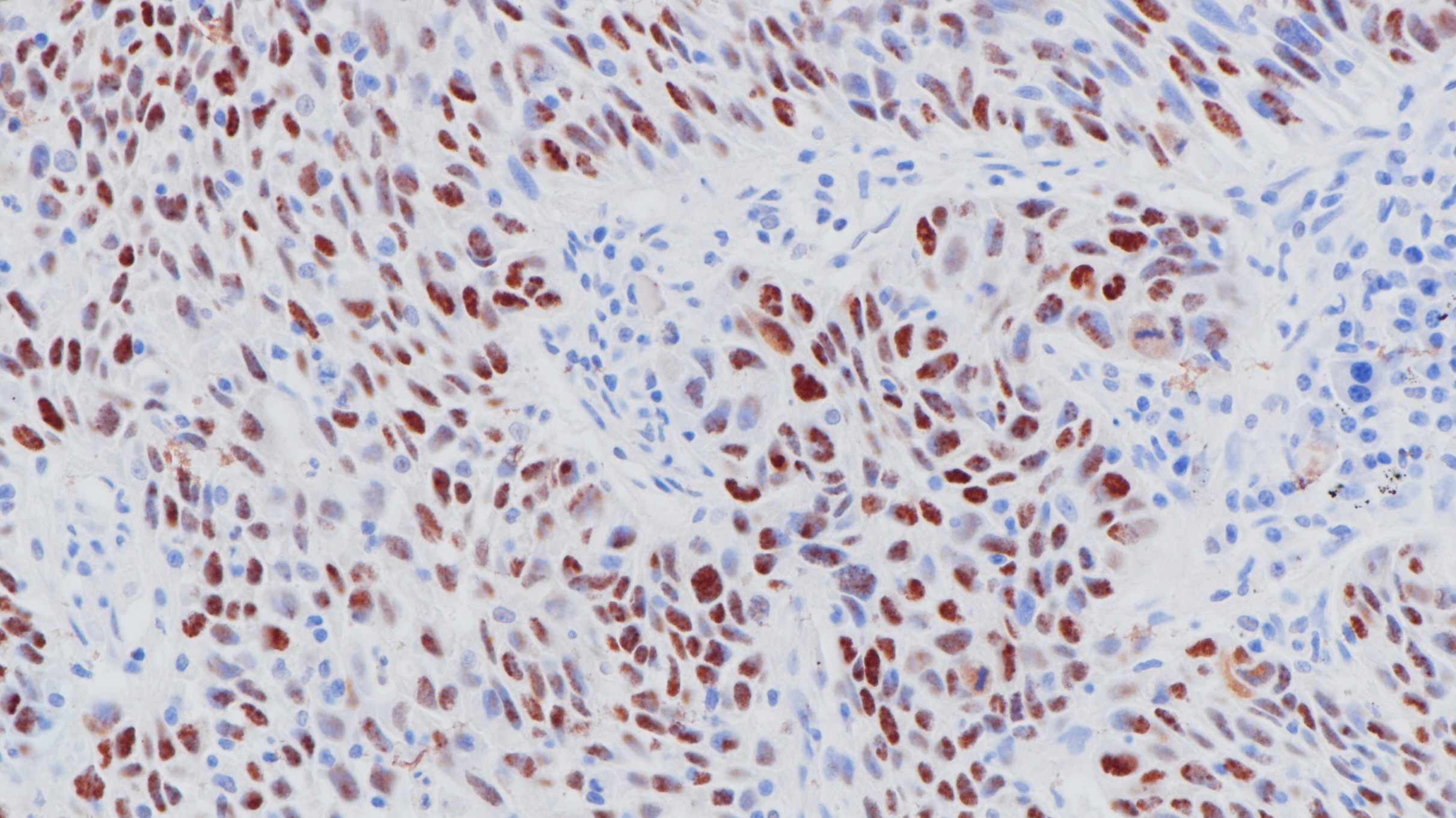 肺鳞癌p53(BPM6168)染色