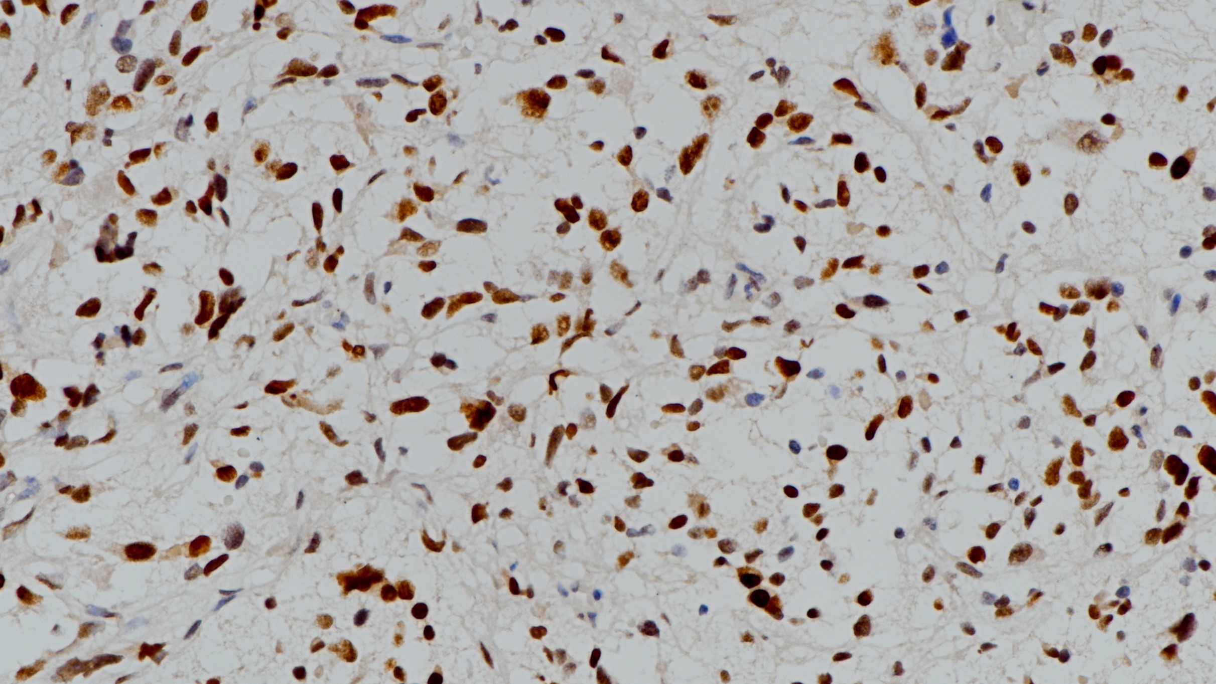 神经母细胞瘤n-Myc(BP6155)染色