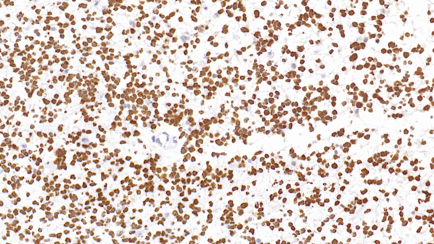 弥漫性脑桥胶质瘤H3K27M(RM192)染色