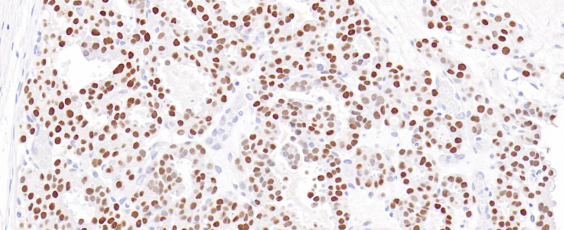 卵巢透明细胞癌HNF1-Beta(EPR18644-13)染色
