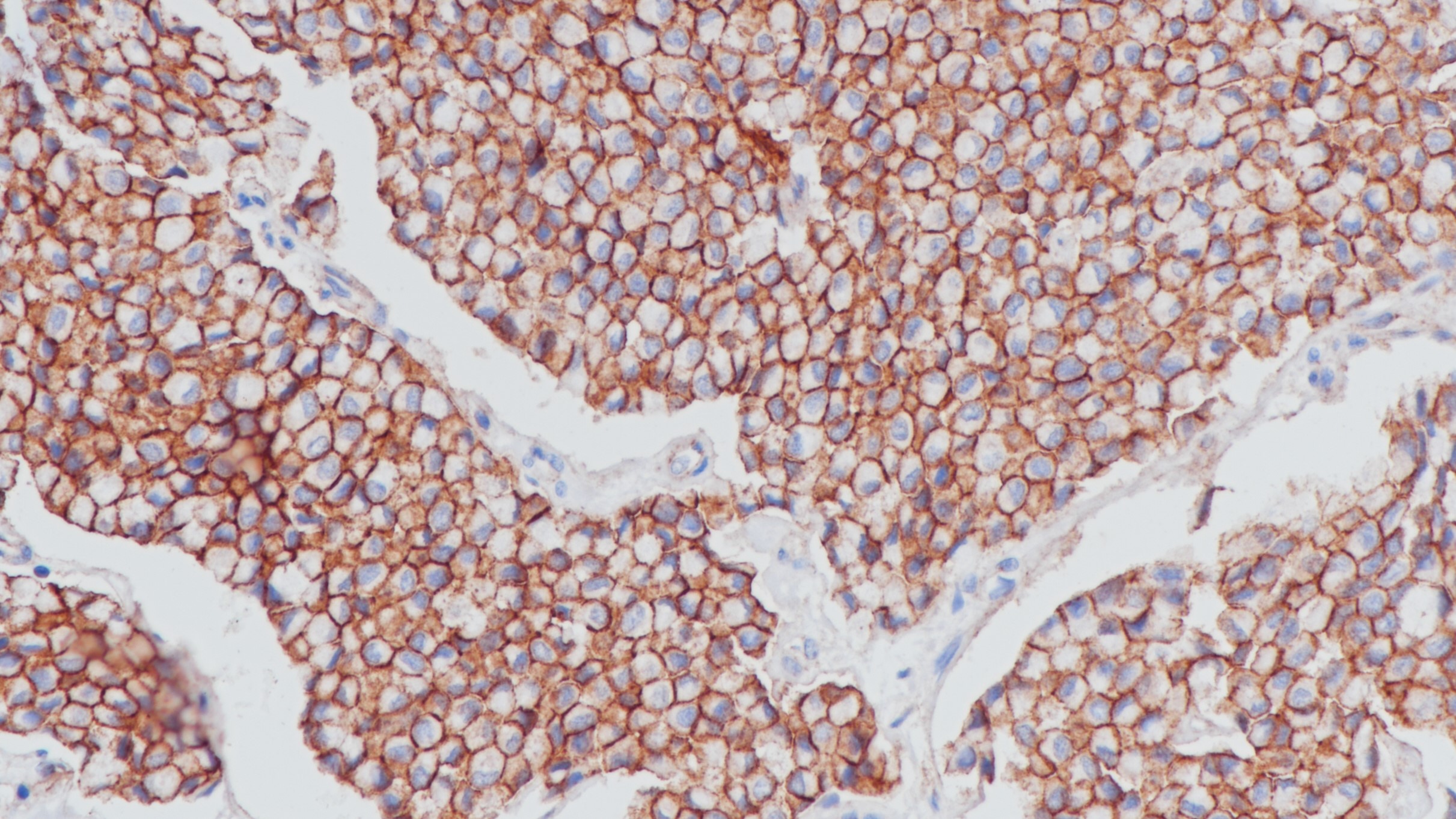 乳腺癌Beta-catenin(BP6159)染色