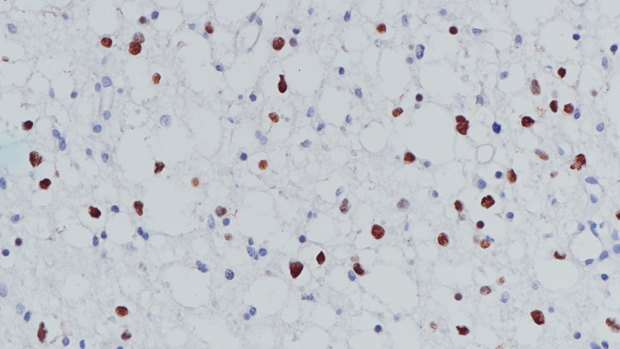 少突胶质细胞瘤Oligo-2(BP6167)染色