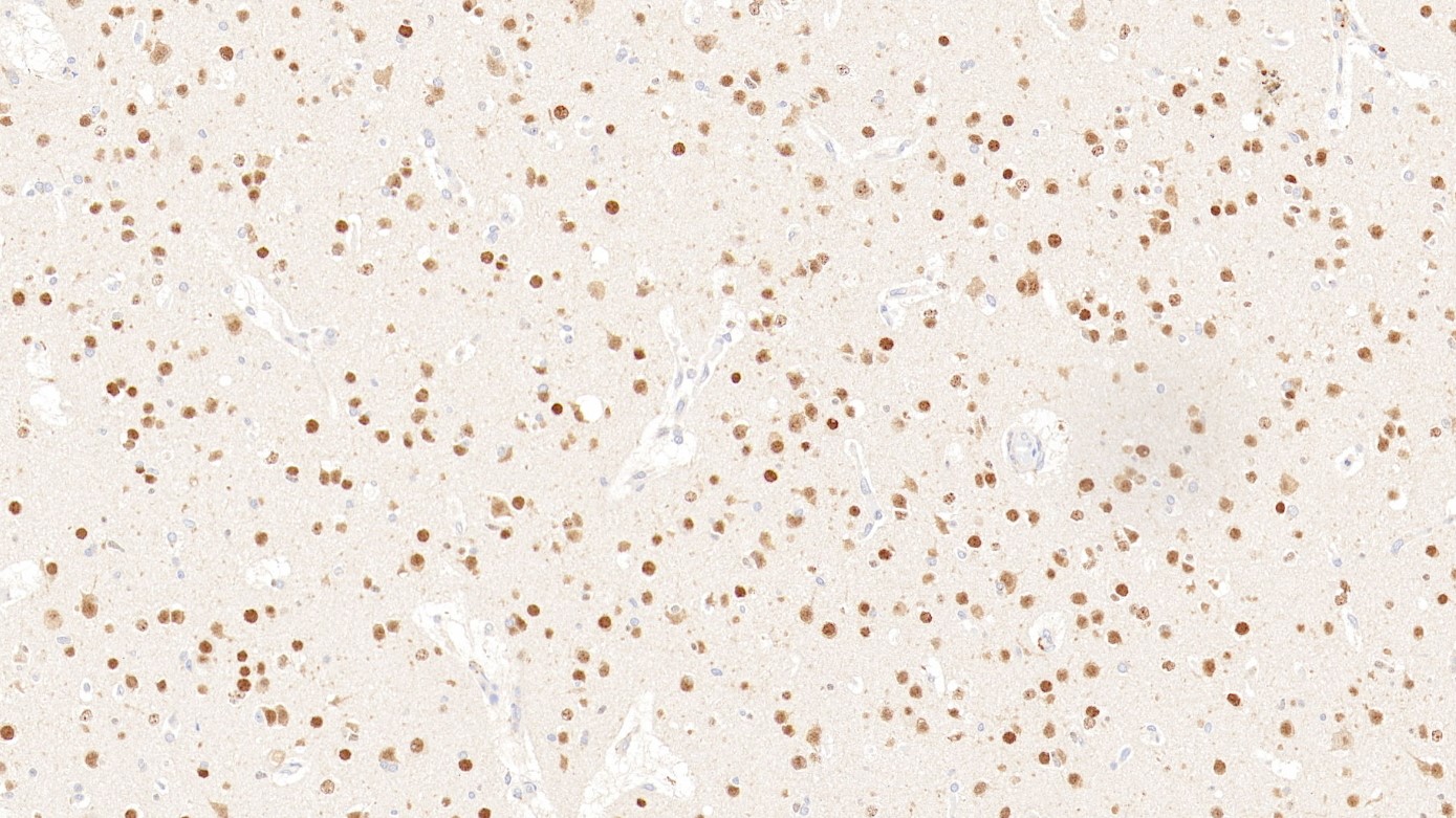脑胶质瘤FOXG1(EPR18987)染色