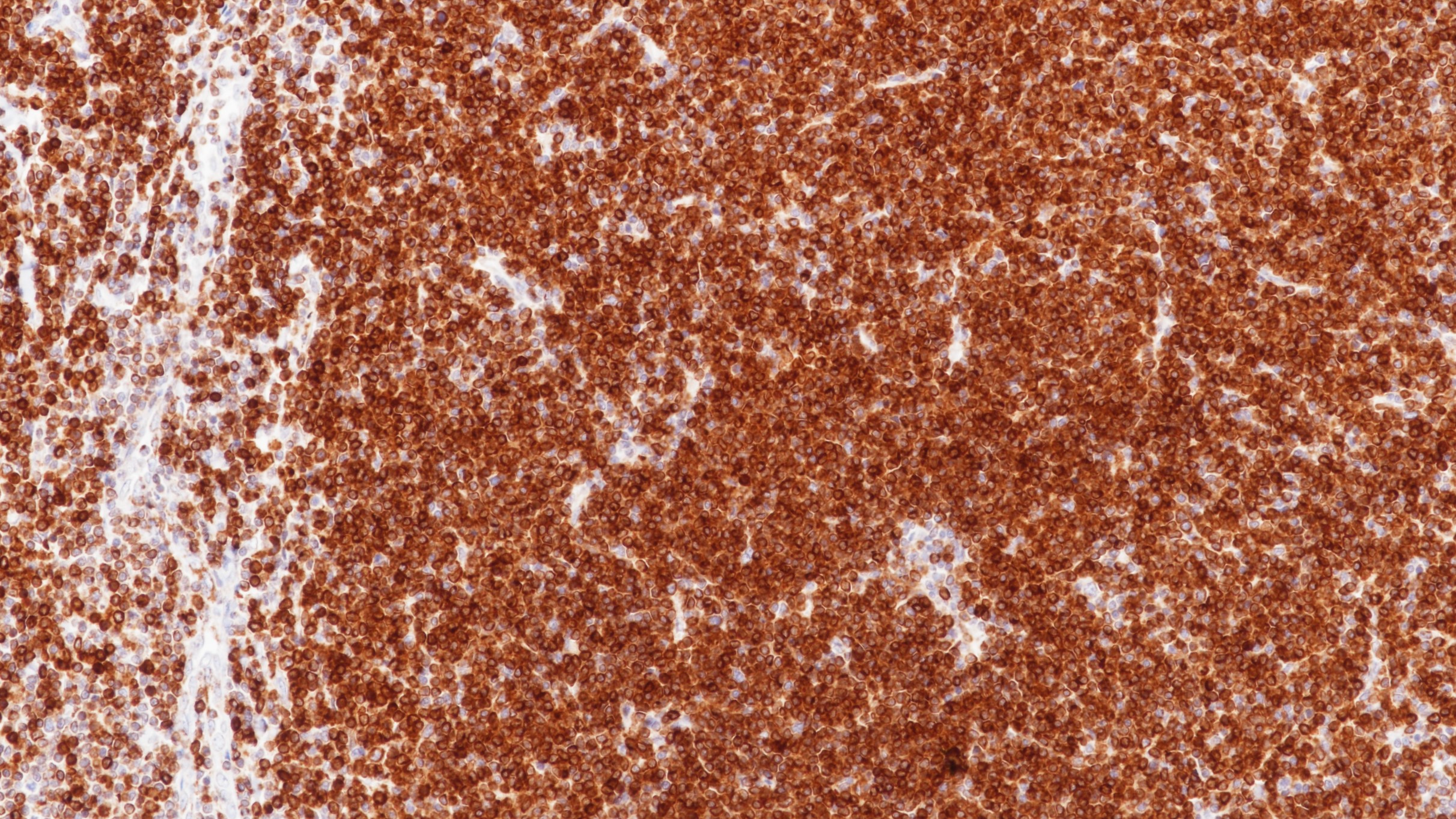 滤泡性淋巴瘤Bcl-2(8C8)染色