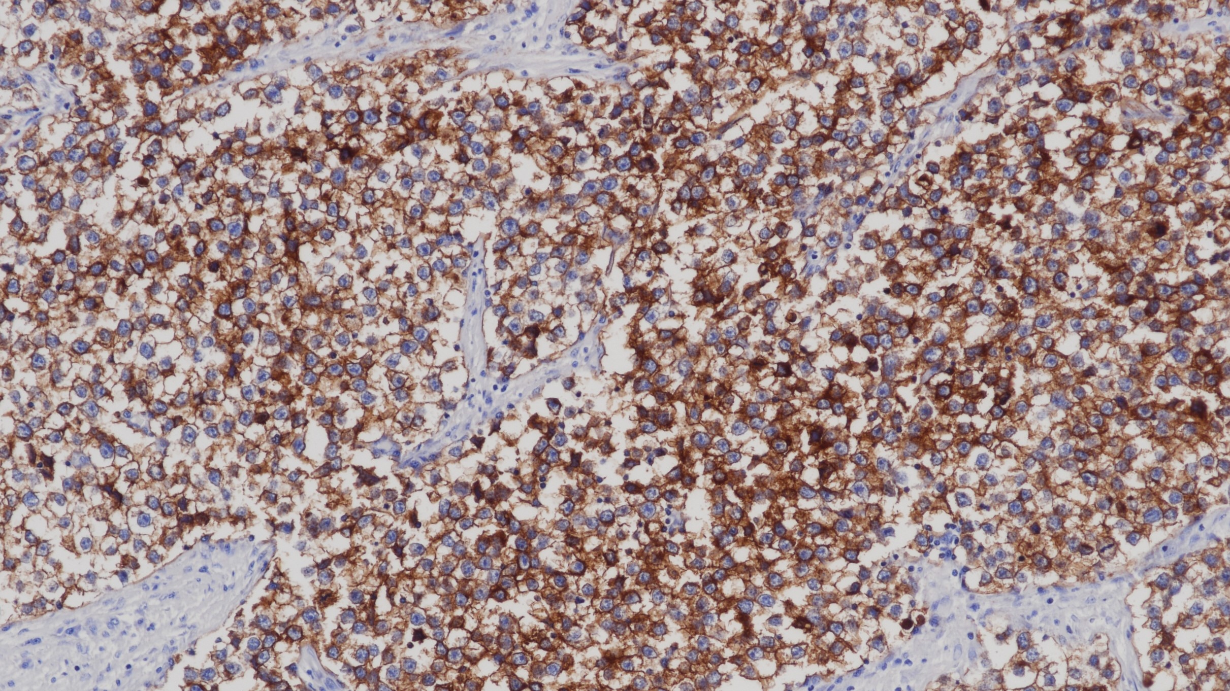 精原细胞瘤PLAP(BPM6151)染色 