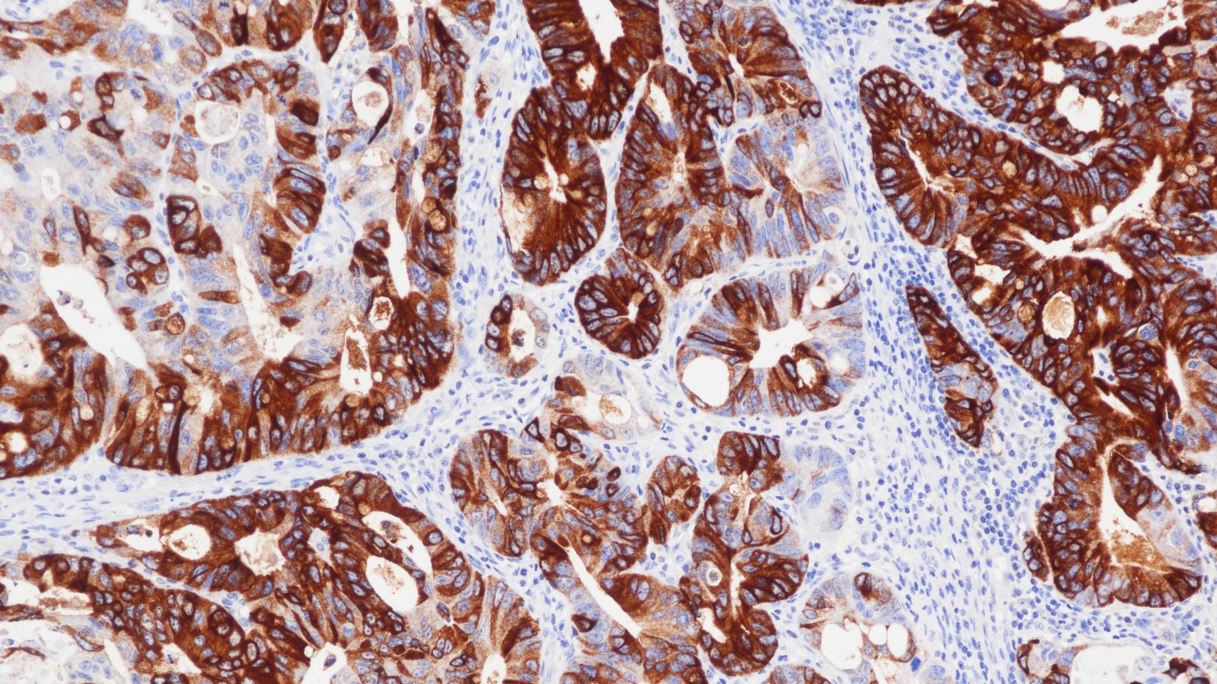 结肠癌MUC2(CCP58)染色