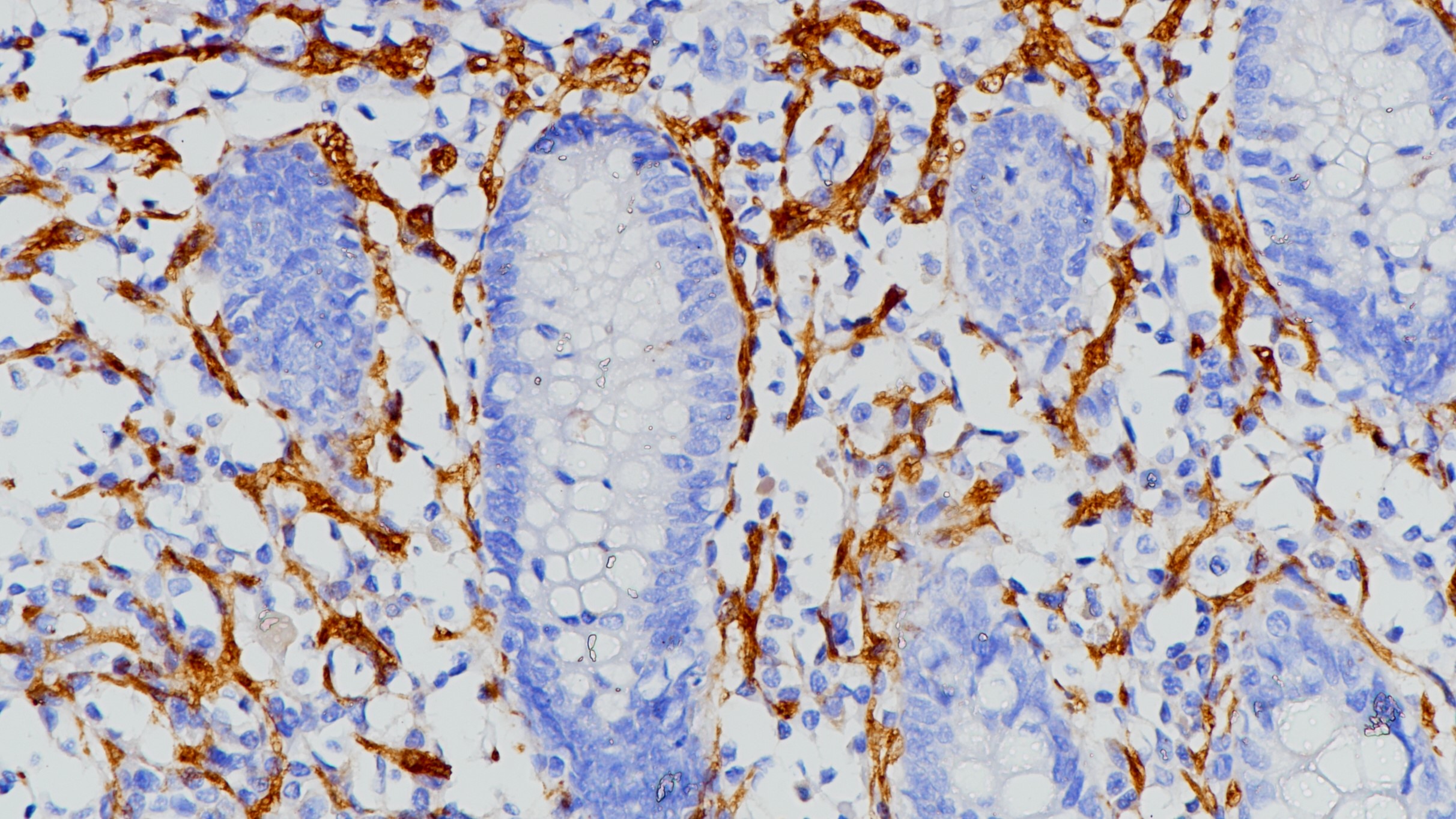 阑尾CD56(123C3.D5)染色
