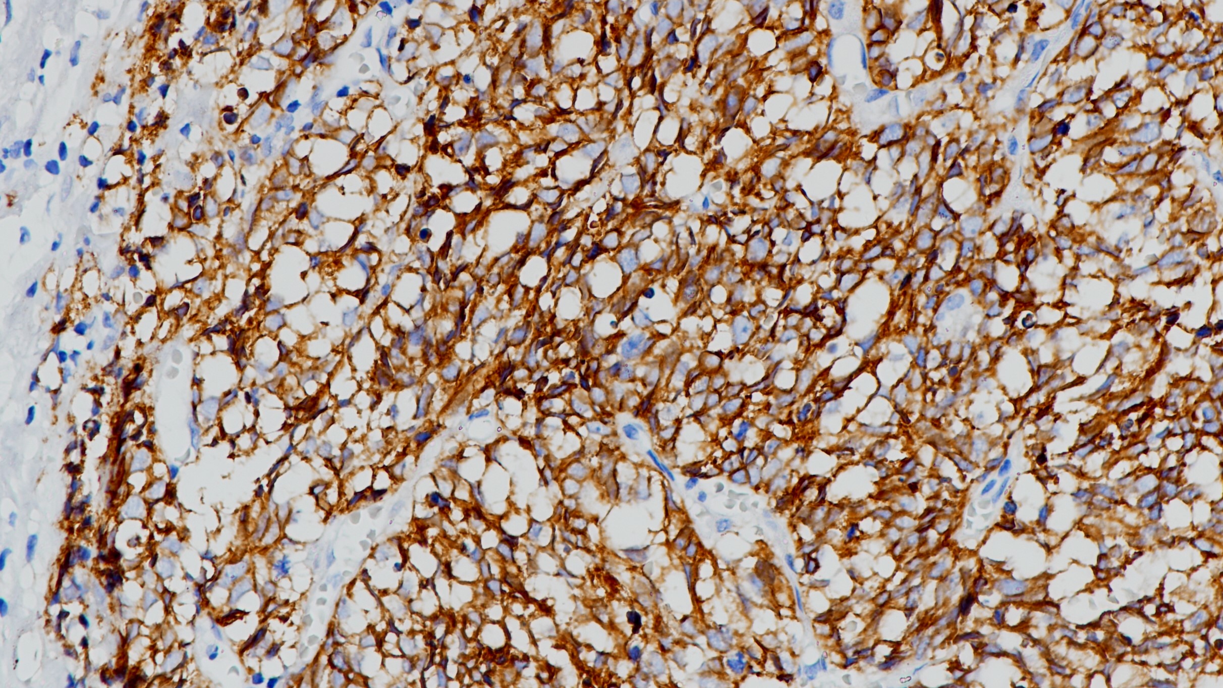 肺神经内分泌癌CD56(123C3.D5)染色