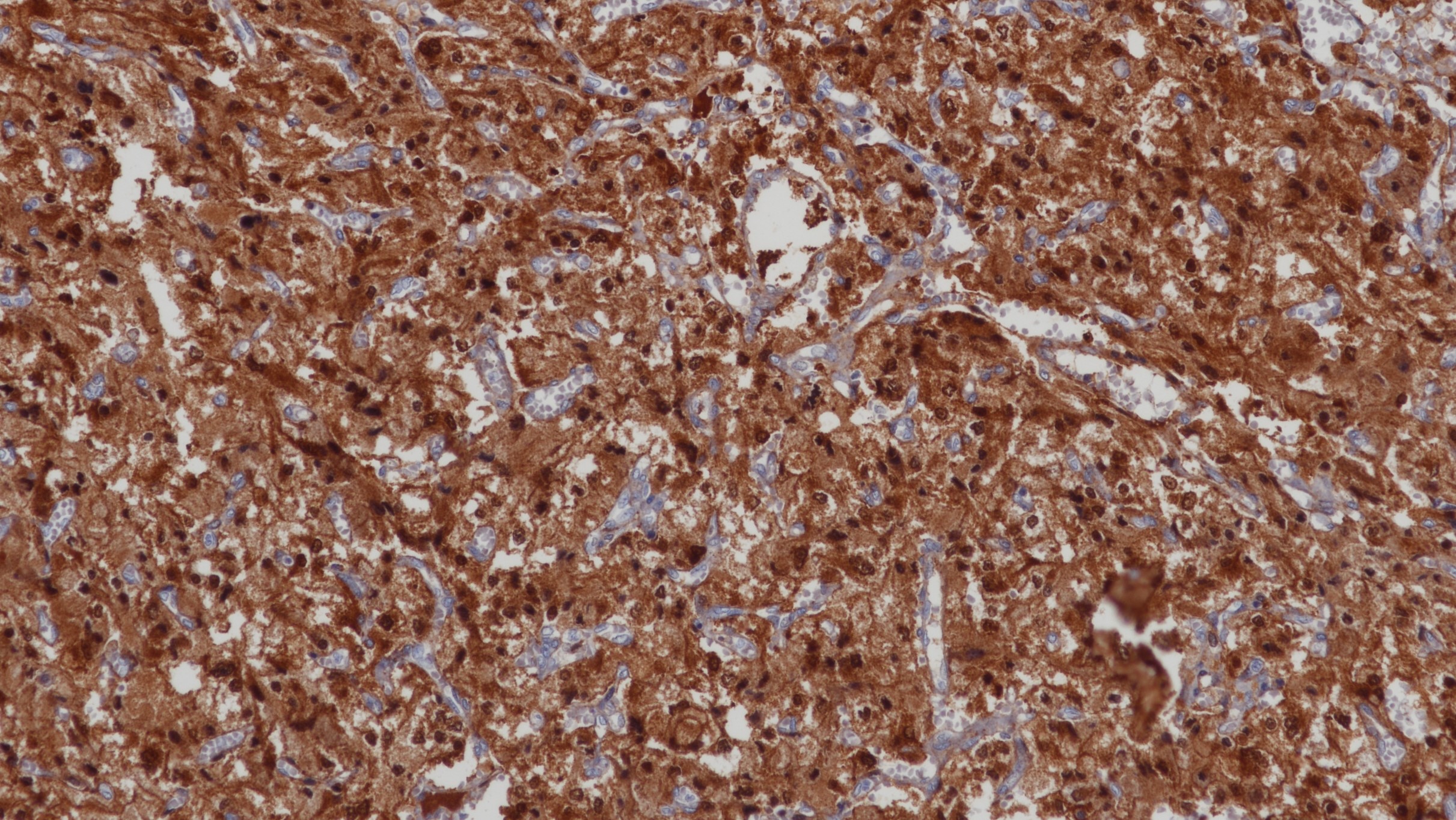 嗜铬细胞瘤NSE(BPM6150)染色