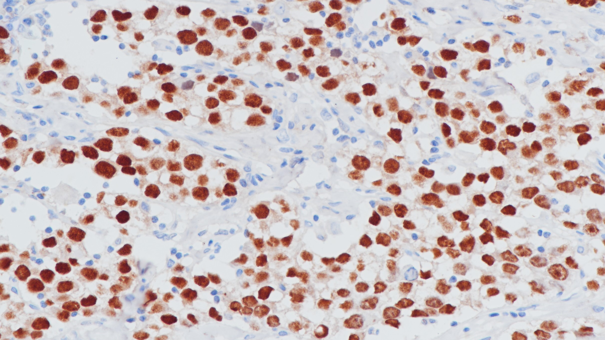 精原细胞瘤Oct34(BP6164)染色