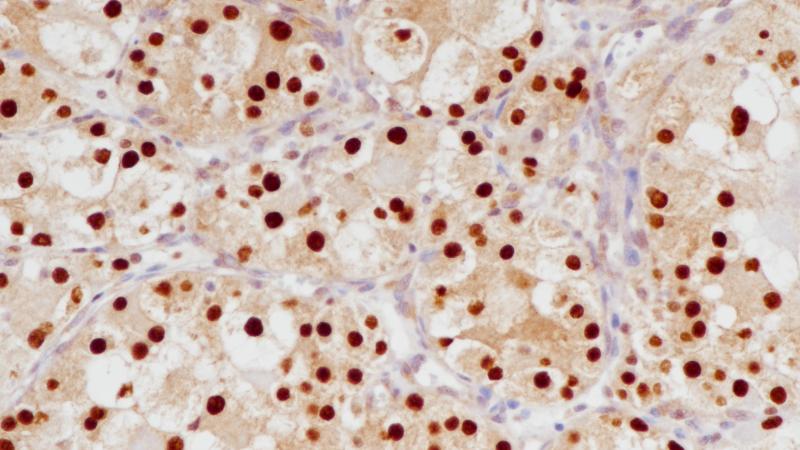 腺泡状软组织肉瘤TFE3(BP6180)染色
