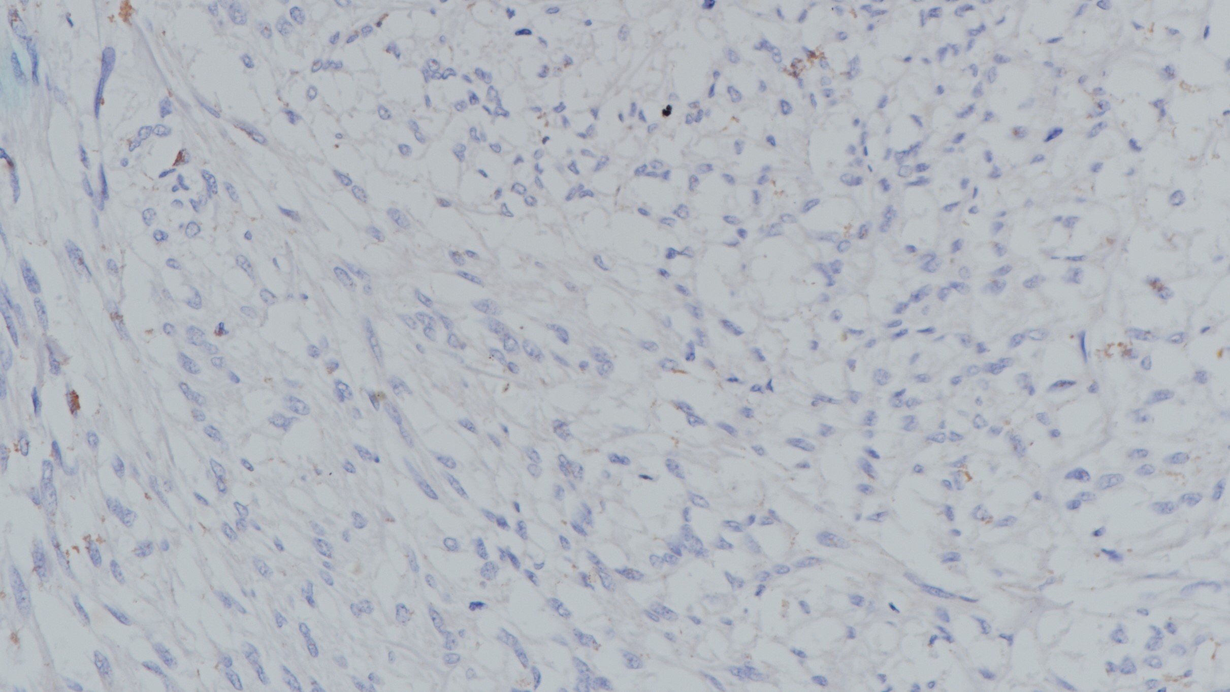 胃肠道间质瘤Oct34(BP6164)染色