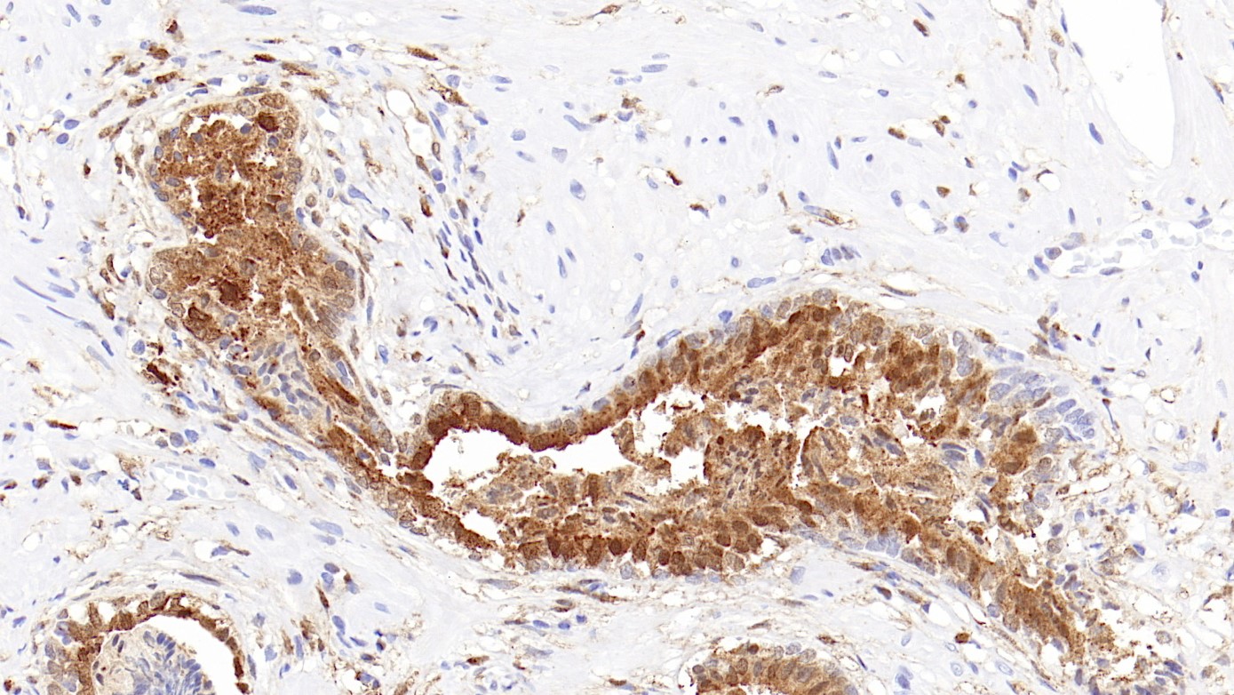 前列腺Galectin-3(EPR19244)染色