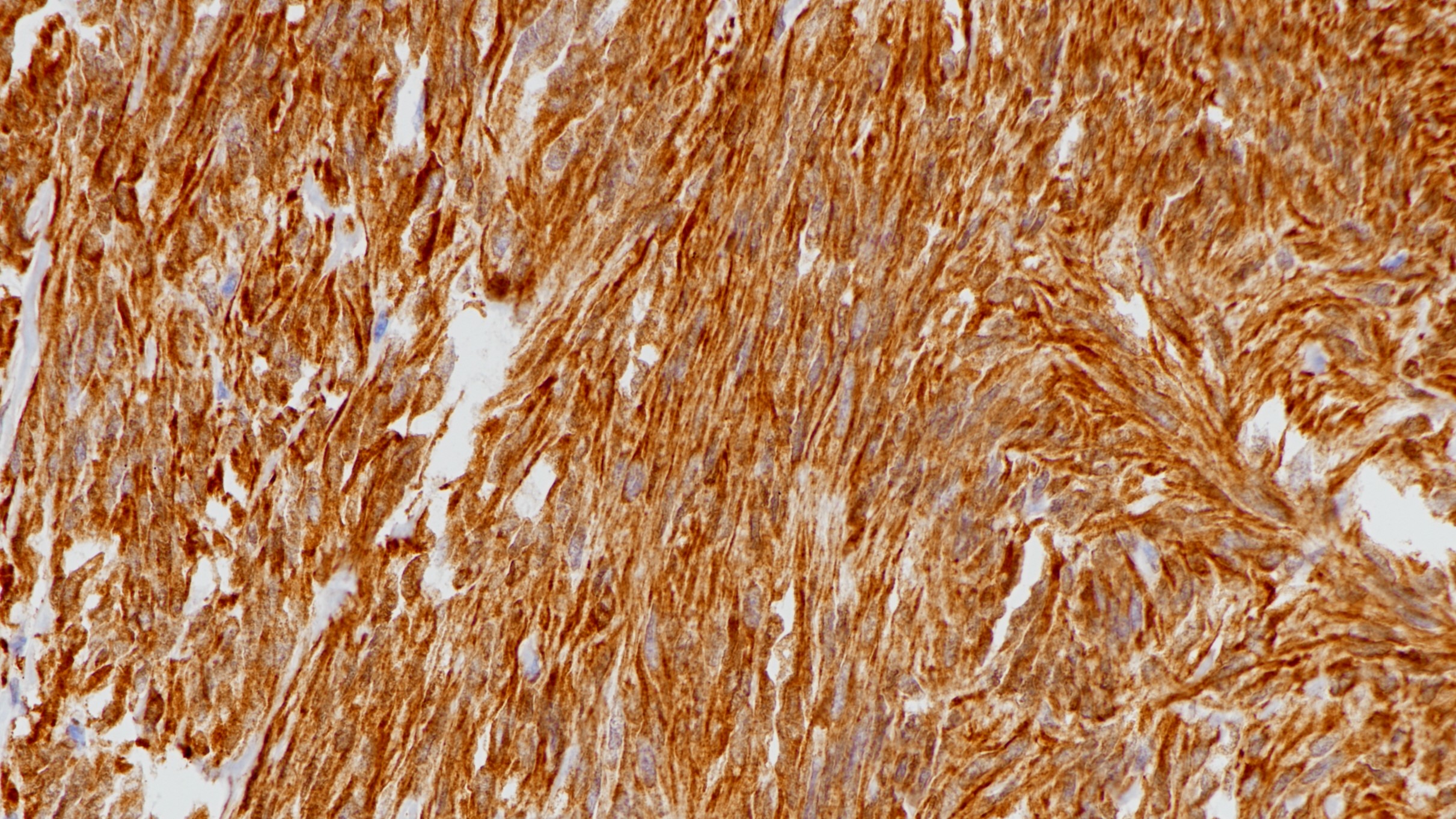胃肠道间质瘤Nestin(10C2)染色