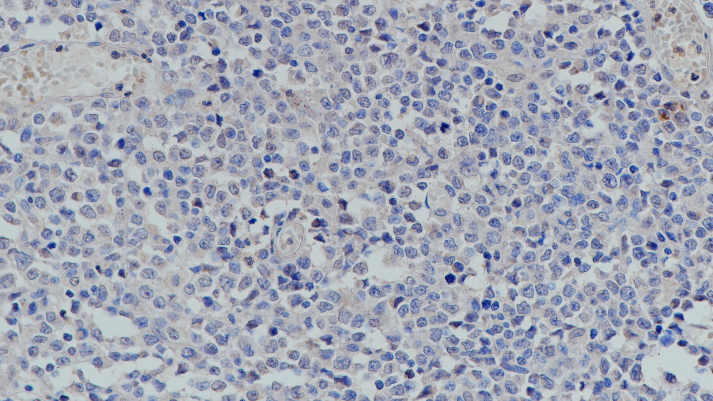 Calretinin(poly)弥漫大B细胞淋巴瘤 阴性组织染色
