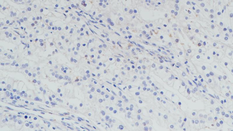 肾透明细胞癌TFE3(BP6180)染色