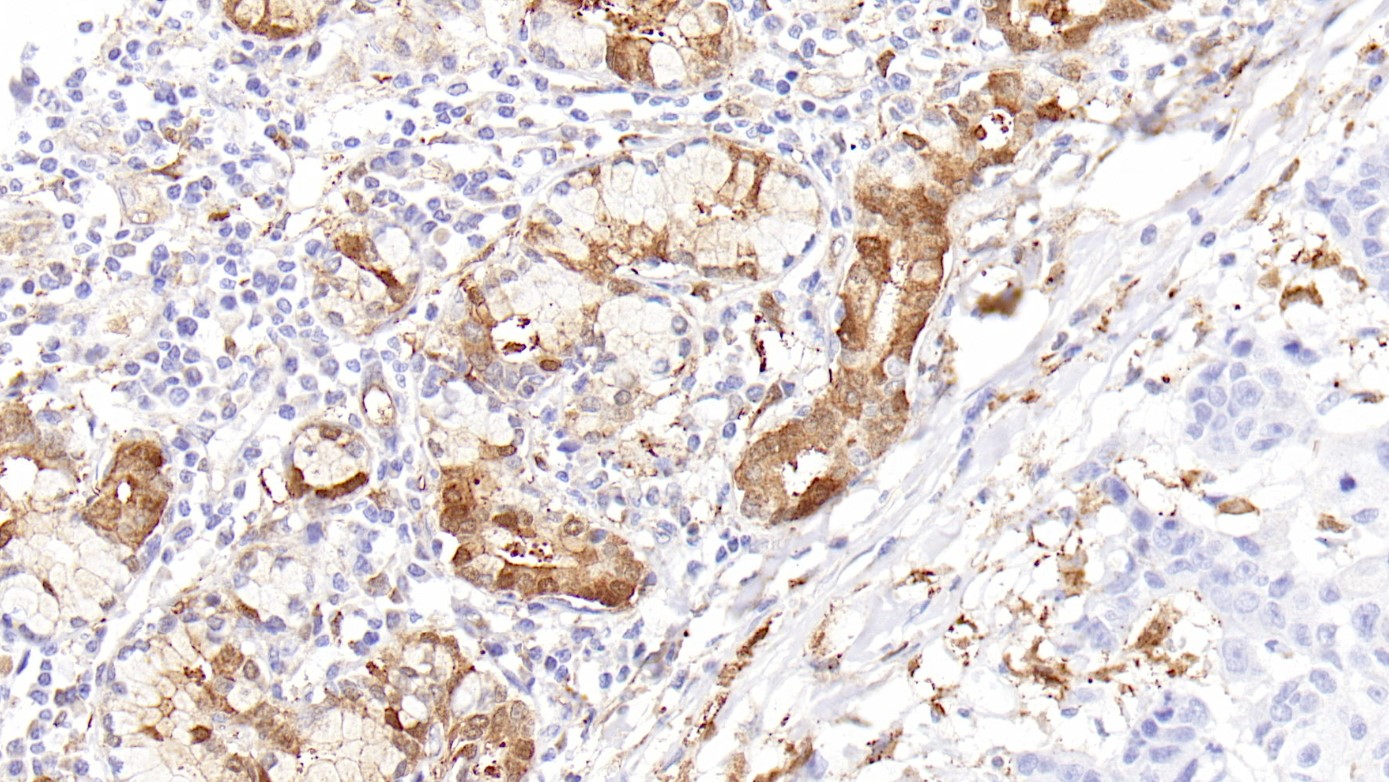 肺腺癌Galectin-3(EPR19244)染色