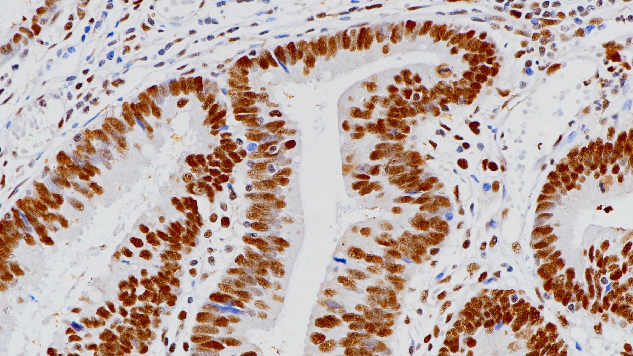 结肠癌MSH2(BP6109)染色