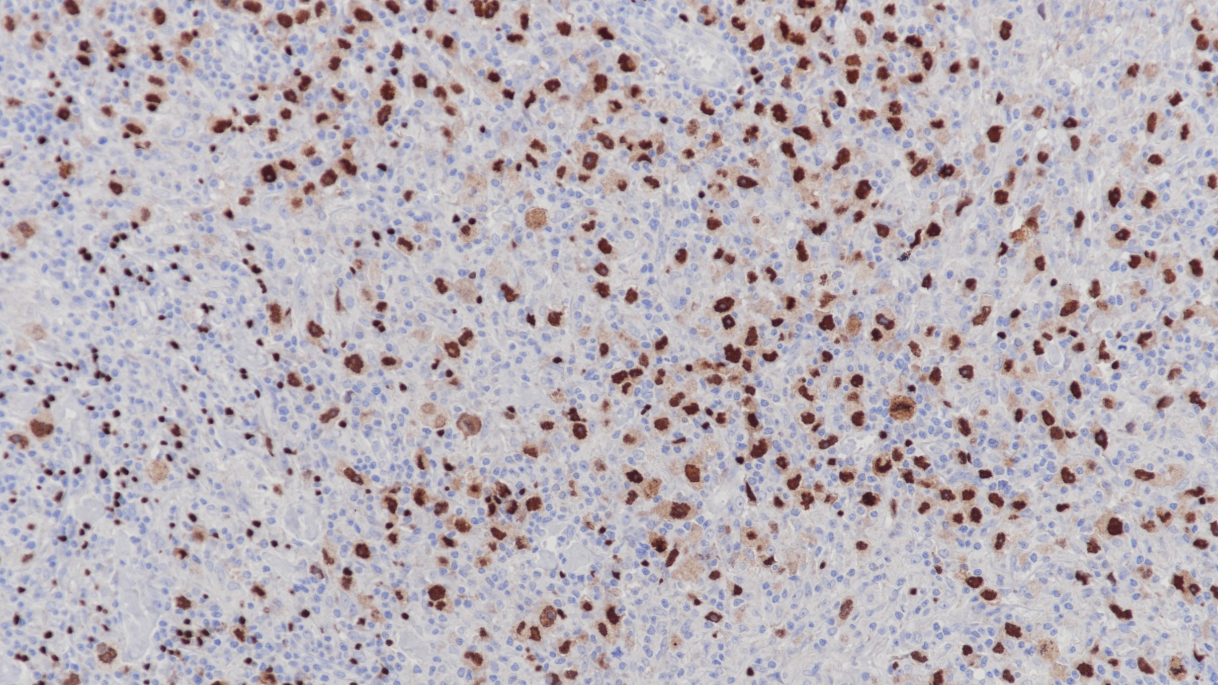 经典型霍奇金淋巴瘤Pax-5(BP6140)染色