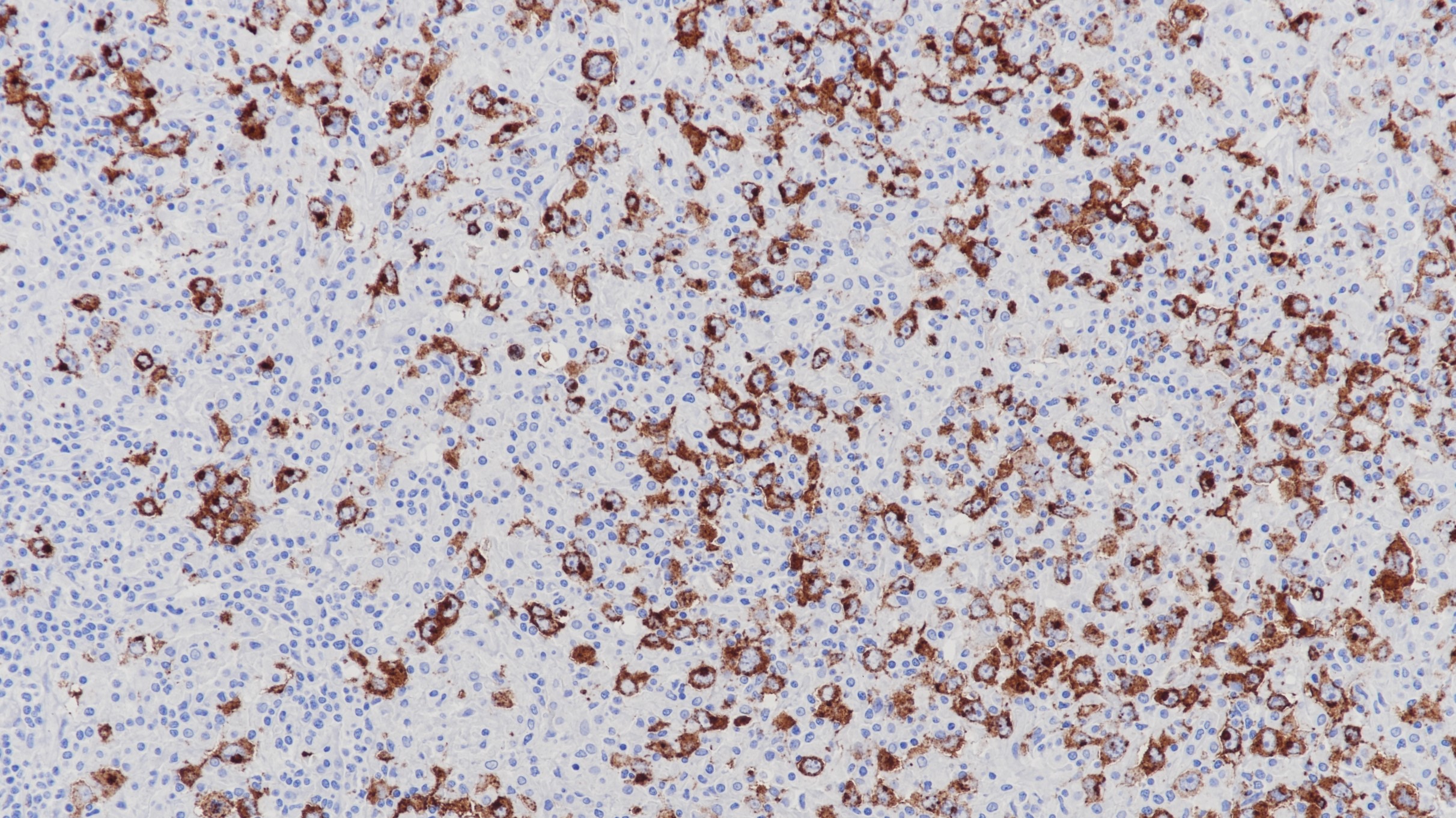 霍奇金淋巴瘤CD15(MMA)染色