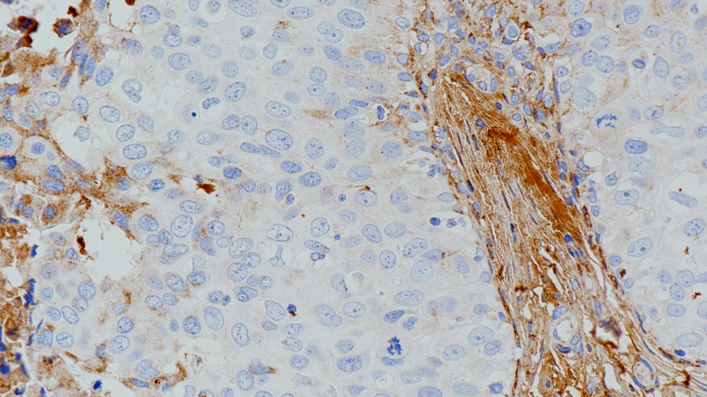 IgM(BP6135)乳腺癌 阴性组织染色