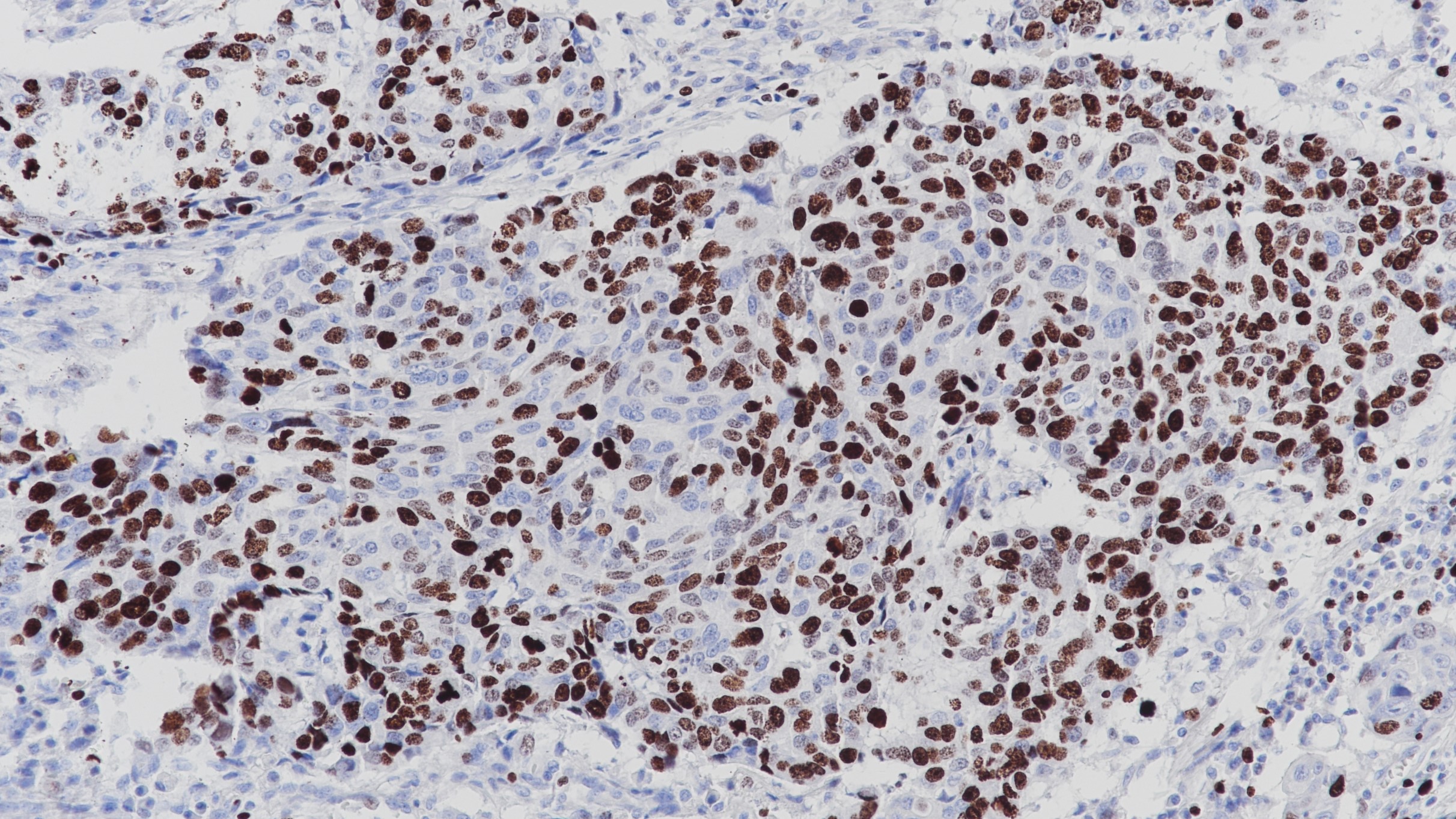 食道癌Ki-67(BP6132)染色