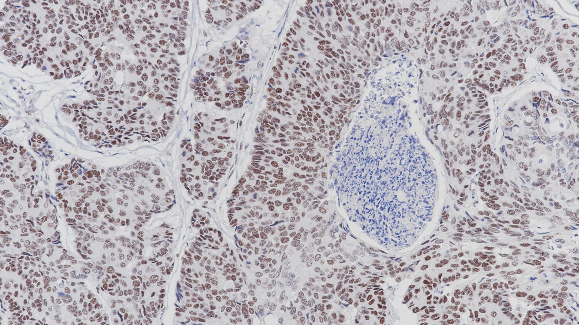 结肠癌PSM2(BP6116)染色