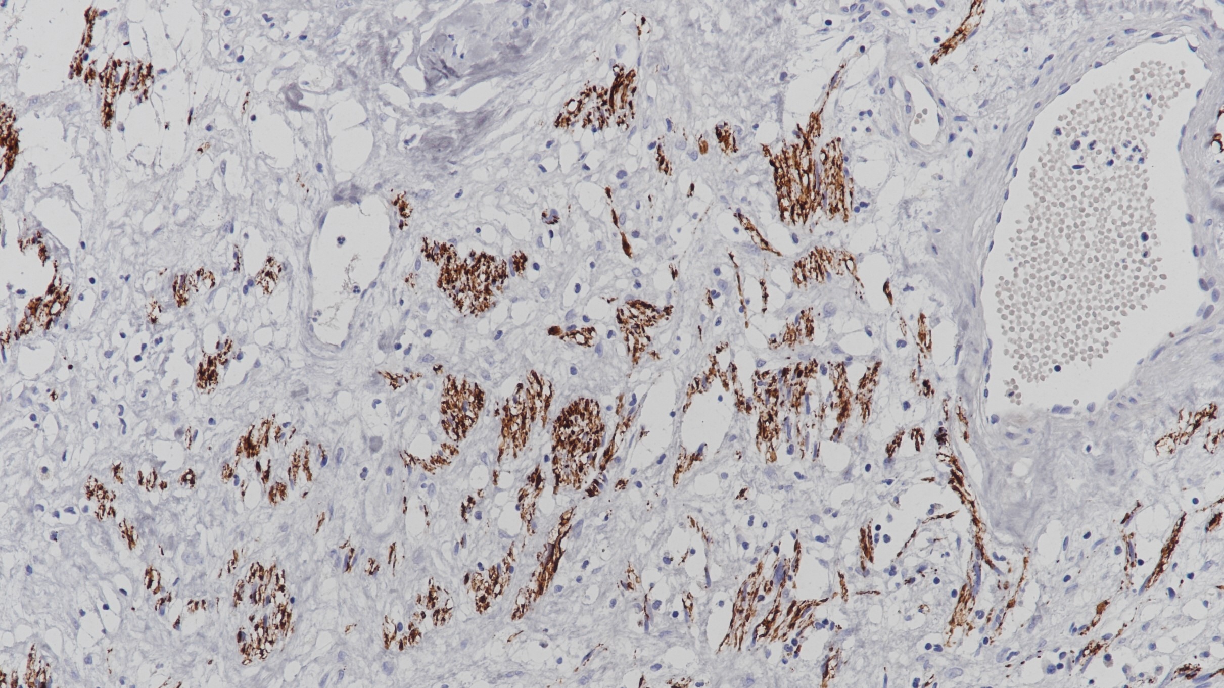 恶性外周神经鞘瘤Neurofilament(2F11)染色