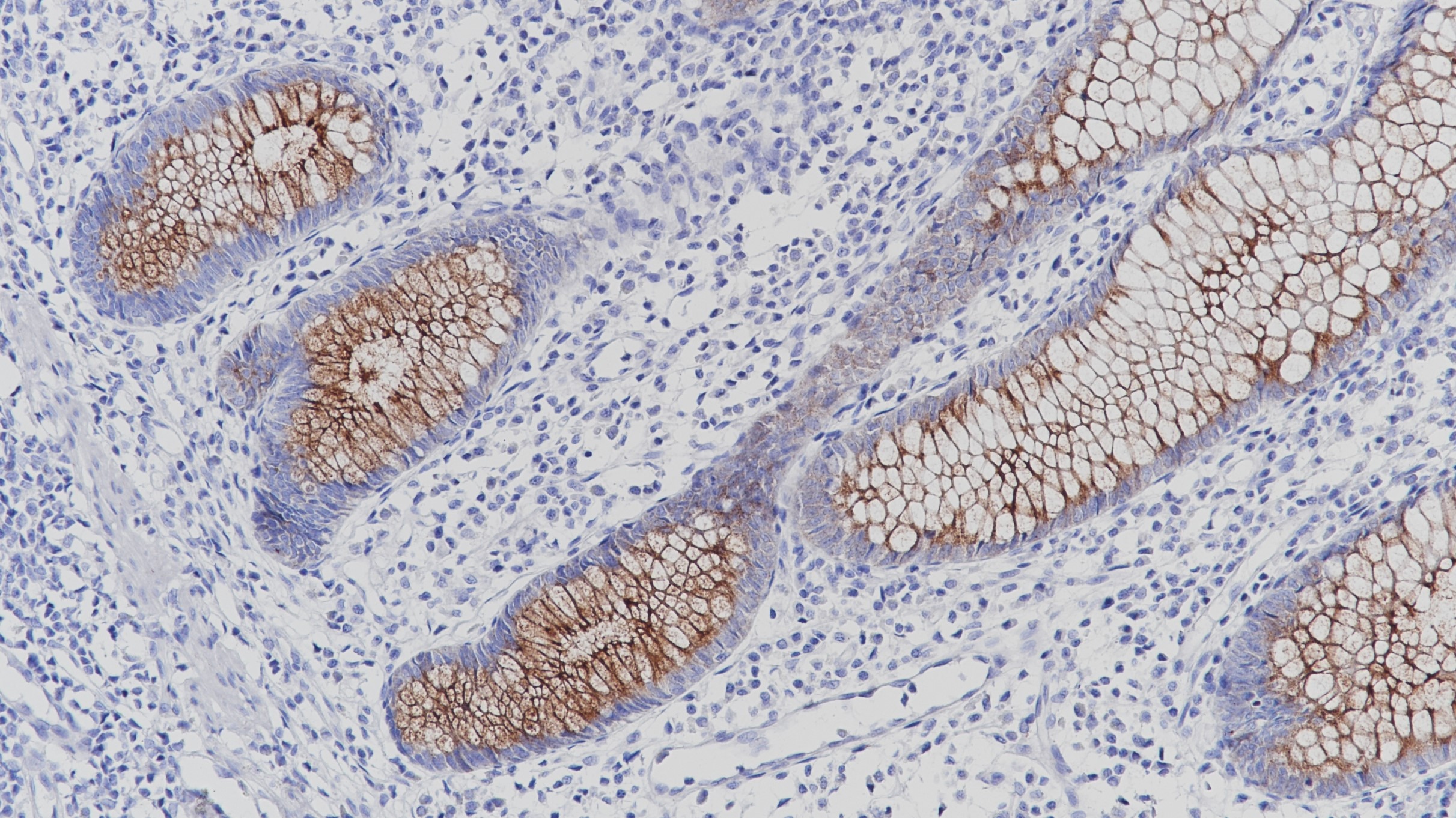 阑尾MUC4(BP6121)染色