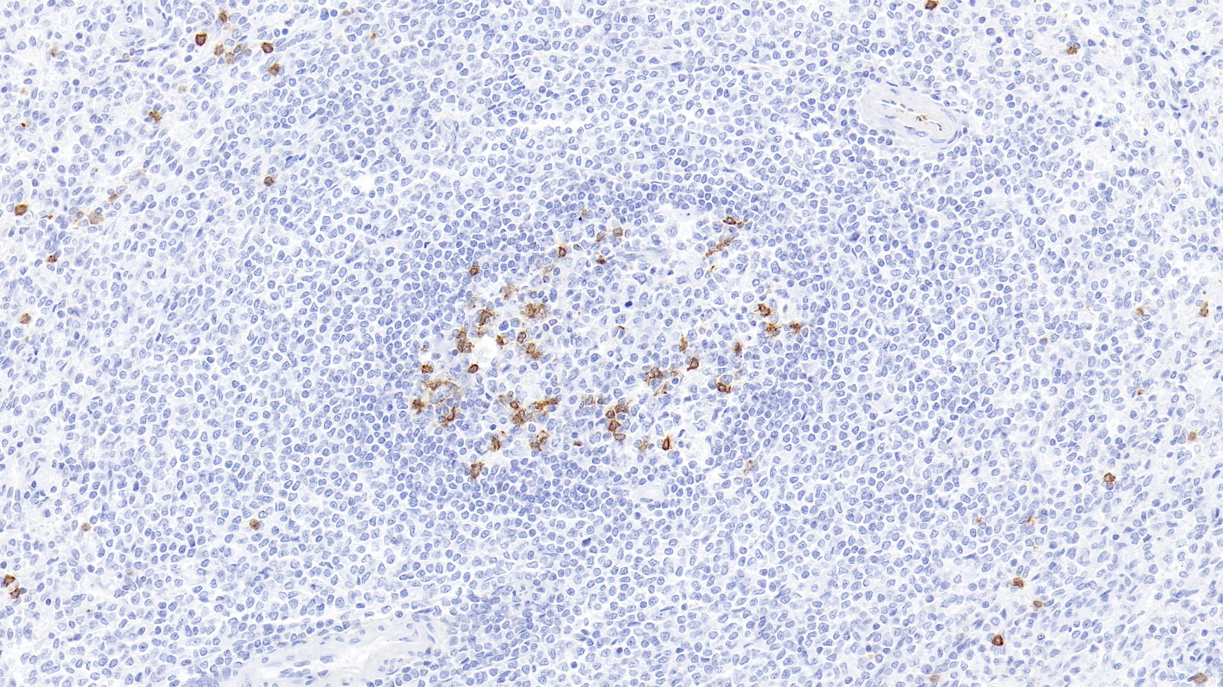 脾脏CD57(MyM1-CD57)染色